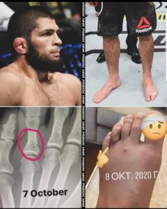 pie roto de khabib